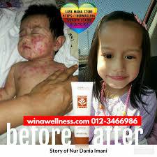 Juga, pada ibu hamil, campak dapat menyebabkan kelahiran prematur atau keguguran. Testimoni Herbalblend Shaklee Untuk Demam Campak