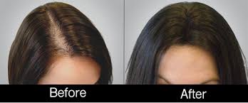 Cottage grove esters store 1729 e. Prp Hair Treatment Chicago Cost Prp Hair Loss Efficacy Safety Cost