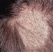 نقط سوداء بفروة الرأس موسوعة hair care fitness beauty beauty