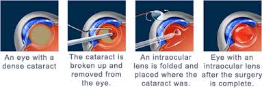 Image result for Cataract Extraction
