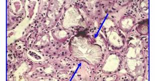 Google Image Result For Http Www Ndt Educational Org Images Fogazzi2007127 Jp Calcium Crystals Renal Calculi
