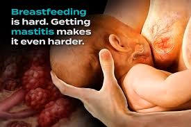 Image result for Mastitis