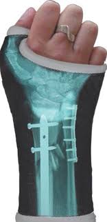 A Company That If You Send Them Your X Ray They Will Send You Back Your Break In Print To Be Applied Directly To Your Cast It Cast X Ray Cool Stuff