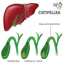 I calcoli alla colecisti, detta anche cistifellea, non sono sempre sintomatici, però possono causarti dolore se si spostano fino ad ostruire il deflusso biliare procurando. Calcoli Alla Cistifellea Cause Dieta E Rimedi