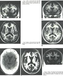 Pdf Magnetic Resonance Imaging In Huntington Disease Semantic Scholar