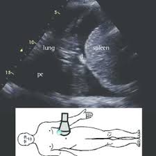 And visible when both pleura are separates by a structure that allows ultrasound transmission; Pdf Lung Ultrasound In The Evaluation Of Pleural Effusion