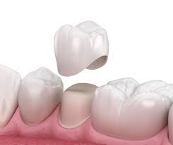 One of the options to restore the size, shape, and strength of your teeth is to get a dental crown with a teeth capping procedure. Different Types Of Dental Crowns 2021 Ilajak Medical