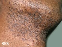 Very often, however, penis bumps are a sign of a relatively benign issue and don't mean a serious penis health crisis is present. How To Treat Ingrown Hair On Penis Ingrown Hair