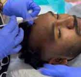 Pdrn is the latest mesotherapy treatment wich has hyaluronic acid  glutathione and salmon dna mixture in a gel form ..., This is injected into  skin in small quantities for pigmentation,uneven skin tone ...