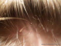 A blonde with perfectly straight hair often has issues finding ways to change up their hairstyle. 22 Pictures Of Head Lice Ideas Head Louse Louse Treatment
