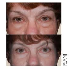 Blepharoplasty Skillman