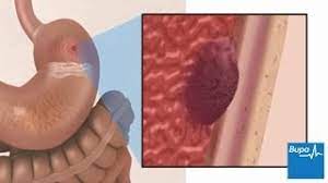 Peptic Ulcers (Stomach Ulcers): Symptoms And Treatments | Bupa Uk