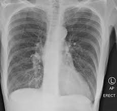 Image result for Emphysema