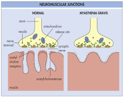 Myasthenia Gravis Medlibes Online Medical Library Myasthenia Gravis Nursing Flashcards Neuromuscular Junction