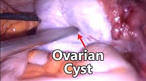Bring your medicine bottles or a list of your medicines when you see your healthcare provider. Ovarian Cyst Removal Surgery Laparoscopic Ovarian Cystectomy Youtube