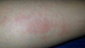 Image result for allergy rash on the legs
