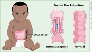 When gastric cancer does produce signs or symptoms, a patient with the illness may experience fatigue, unintentional weight loss, loss of appetite, abdominal pain or discomfort, nausea, vomiting, bloody or black stools, heartburn, and indigestion. Intussusception For Parents Nemours Kidshealth
