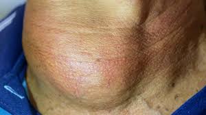 Thyroid cancer is a rare cancer with 4 different types. Anaplastic Thyroid Cancer Faqs What You Need To Know Dr Seeds