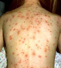 Varsatul de vant nu are o medicatie aparte, nefiind nevoie de un tratament de specialitate. Varicela Varsatul De Vant La Copii Simptome Si Tratament