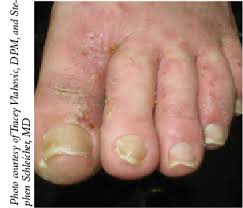 I find that it works better to file the callus when it's still hard, then soak my feet to soften. A Guide To Dry Skin Disorders In The Lower Extremity Podiatry Today