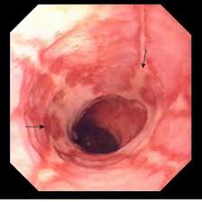 Pylori restores gastric acid production and, in individuals predisposed to gastroesophageal reflux, could possibly contribute. Gastroesophageal Reflux Disease Gerd Digestive Disorders Msd Manual Consumer Version