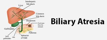 It can be congenital or acquired. Biliary Atresia Causes Symptoms And Treatment