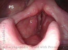 Image result for Acute Laryngitis