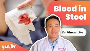 Image result for Blood in stool