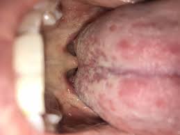 Image result for Puchýře na jazyku