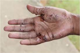 Image result for scabies effects on the human body
