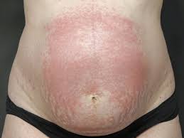 Image result for pruritic urticarial papules and plaques of pregnancy