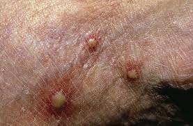 Image result for Fire Ant Sting