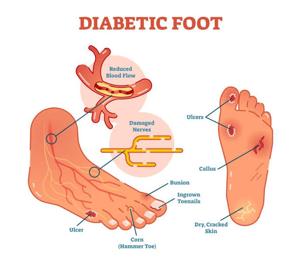 Common Diabetic Foot Complications, AI generated