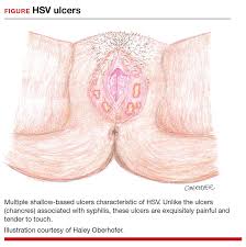 Image result for genital herpes