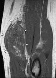 Pain in the upper thighlearn about different causes of upper thigh pain, from injuries to nerve problems. Mr Imaging Of Atraumatic Muscle Disorders Radiographics
