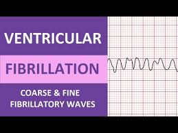 Image result for Ventricular Fibrillation