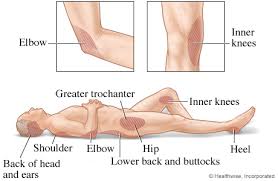 There are a number of areas in the upper back that can become sore and irritated, but the one i am referring to involves trigger points in the rhomboid muscles. Common Areas Where Pressure Injuries Develop Texas