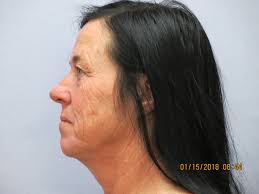 With Raleigh Plastic Surgery Centers neck lift procedure you can say  goodbye jowls and sagging skin. Our surgeons are able to transform and  redefine this patient's neck and jawline, giving her a