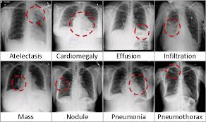 Chestx Ray8 Hospital Scale Chest X Ray Database And Benchmarks On Weakly Supervised Classification And Localization Of Common Thorax Diseases Arxiv Vanity