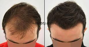 زراعة الشعر في الرياض تجربتي