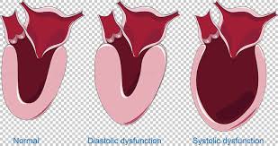 Image result for Systolic Dysfunction