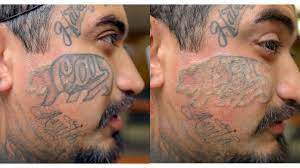 $50 as you increase the level of surface area, with the largest tattoos taking up to $500 per session to remove. Tattoo Removal How To Costs Before And After Pictures More