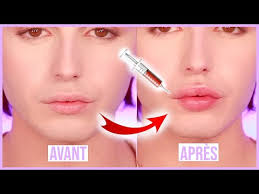 MES INJECTIONS dans les lèvres! AVANT APRES