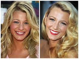 Get dashing new veneers fitted by the experts at harley street. Celebrity Veneers Blake Lively Veneers Celebrities With Veneers Veneers Teeth Lip Fillers