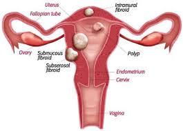 While avoiding certain foods can help you with your fibroid symptoms, proper treatment recommended by your doctor or a fibroid specialist is always best. Uterine Fibroids Causes Treatment Options Kjk Hospital Trivandrum