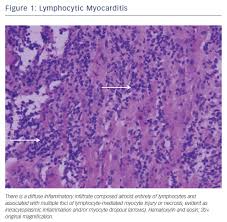 Symptoms can include shortness of breath, chest pain, decreased ability to exercise, and an irregular heartbeat. Fulminant Myocarditis A Review Of The Current Literature Usc Journal