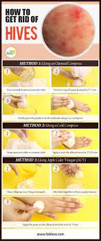 How To Get Rid Of Hives Naturally With These Home Remedies Remedies Natural Acne Remedies Natural Healing Remedies