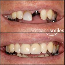In addition to the above procedures, your plan will also save on dental work like implants, veneers, bone grafts, ceramic crowns, adult. Dental Implants Brisbane Tooth Replacement Brisbane Smiles Toowong