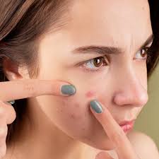 We all deserve clear skin. 5 Amazing And Effective Home Remedies To Get Rid Of Pimple Scars Naturally Pinkvilla