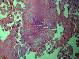 Once rare in developed countries, tuberculosis infections began increasing in 1985, partly because of the emergence of hiv, the virus that causes aids. Rare Cases Of Urogenital Tuberculosis And Atypical Mycobacterial Urogenital Infection Publisso